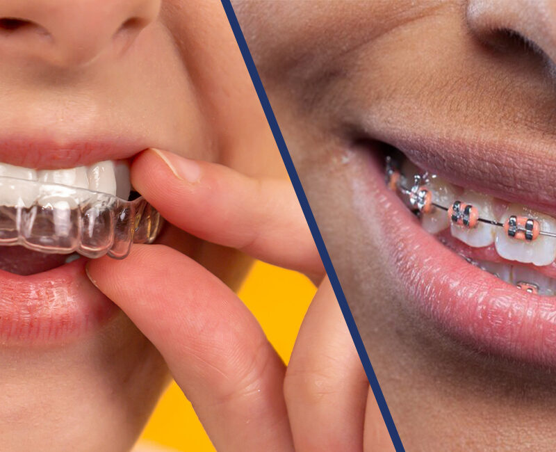 Two pictures of a woman with braces on her teeth, showcasing the difference between clear aligners and traditional braces.