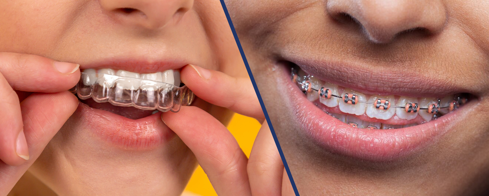 Two pictures of a woman with braces on her teeth, showcasing the difference between clear aligners and traditional braces.