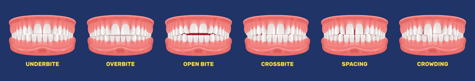 A diagram illustrating the progression of tooth decay, including stages of Open Bite, Crossbite, Overbite and Underbite.
