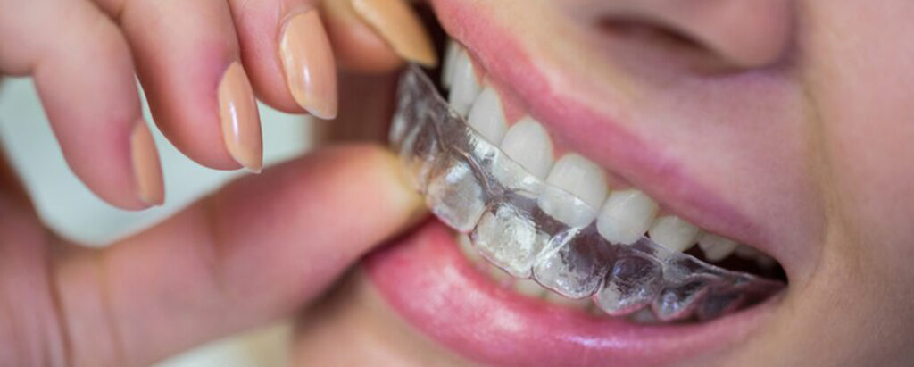 A woman is putting her invisible aligners on her teeth.