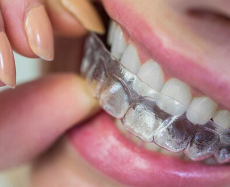 A woman is putting her invisible aligners on her teeth.