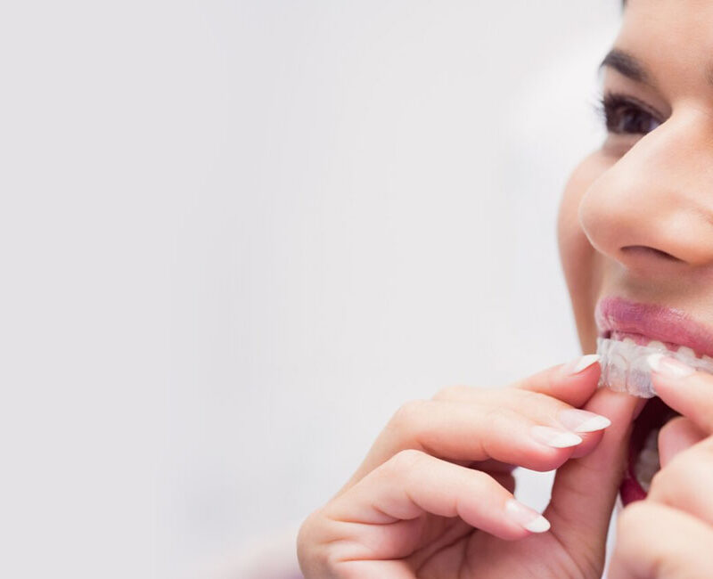 A woman is wearing invisible braces as a convenient solution for teeth straightening.