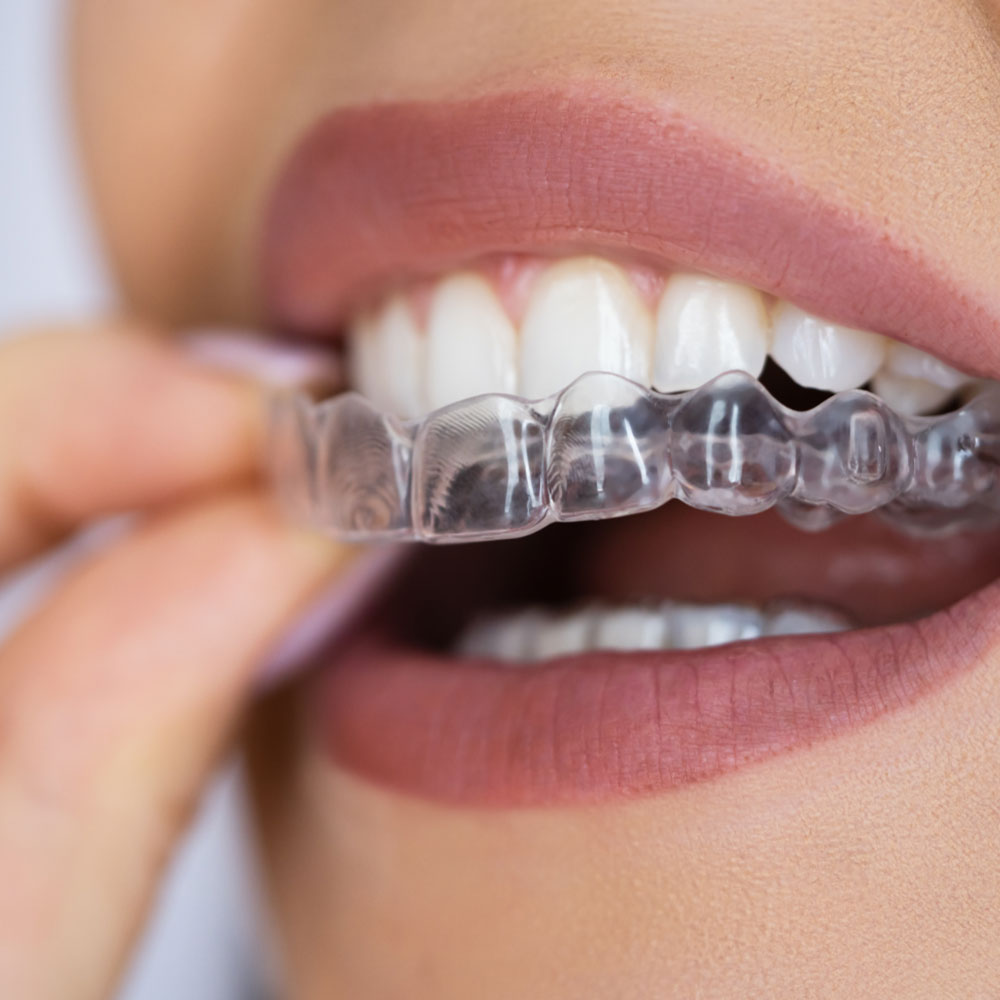 how clean aligners works at home