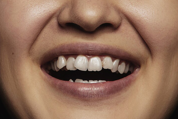 A close up of a woman’s mouth with misaligned teeth.