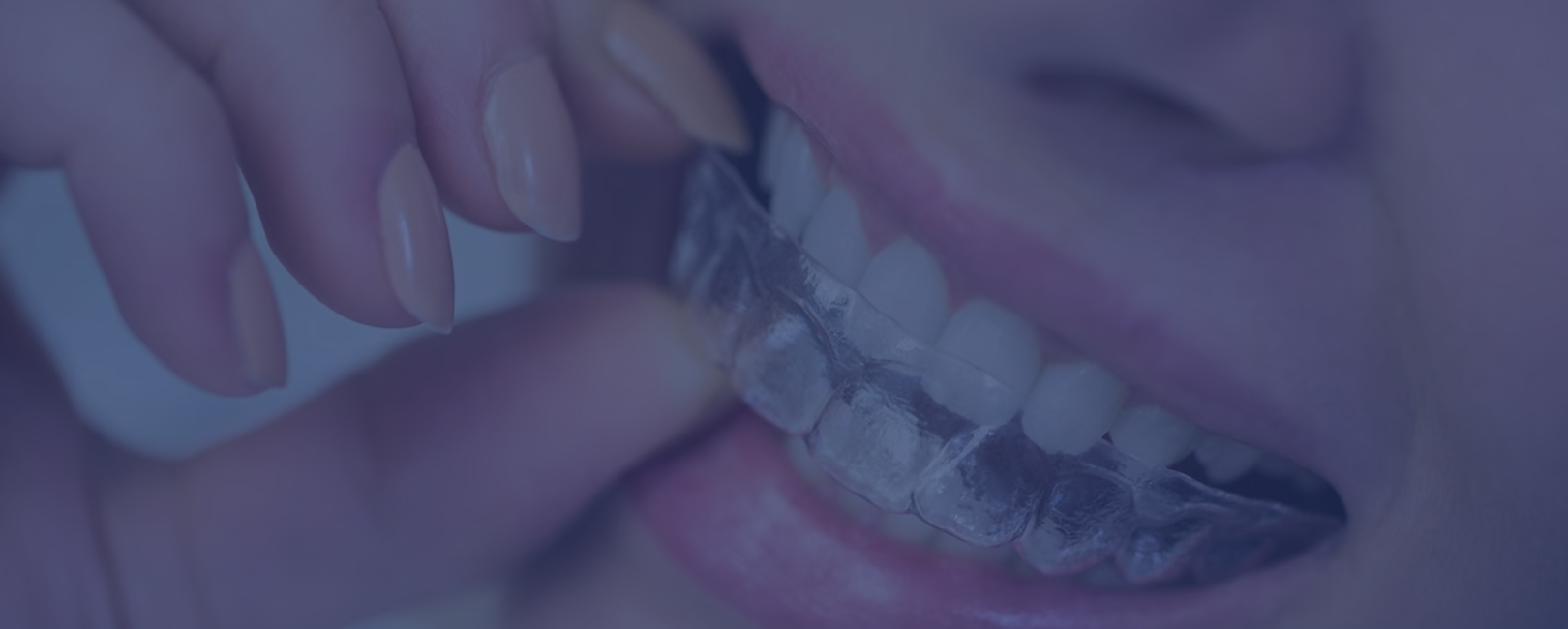 Person inserting clear aligners into their mouth.