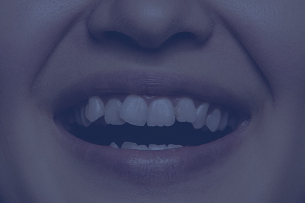 Close-up of a person's smiling mouth with clear aligners and a blue tint.