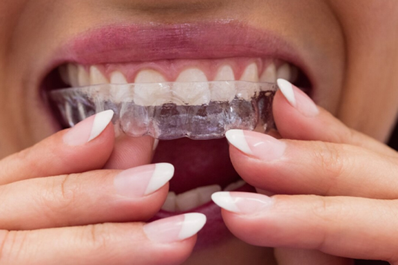 A woman is undergoing clear aligner treatment for open bite teeth