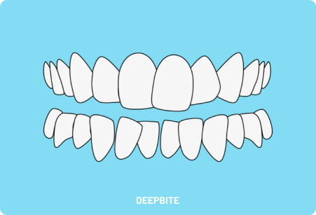 An illustration of deep-bite teeth on a blue background.
