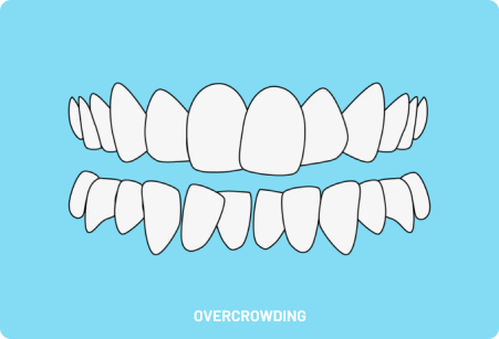 Overcrowding teeth on a blue background due to overcrowding