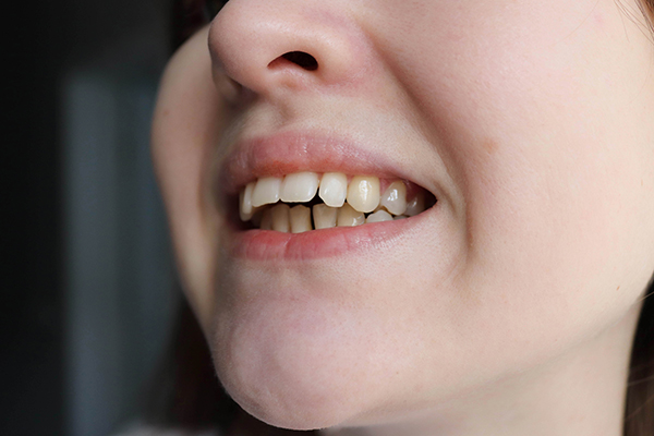 Overbite Solutions Explained: Your Comprehensive Guide
