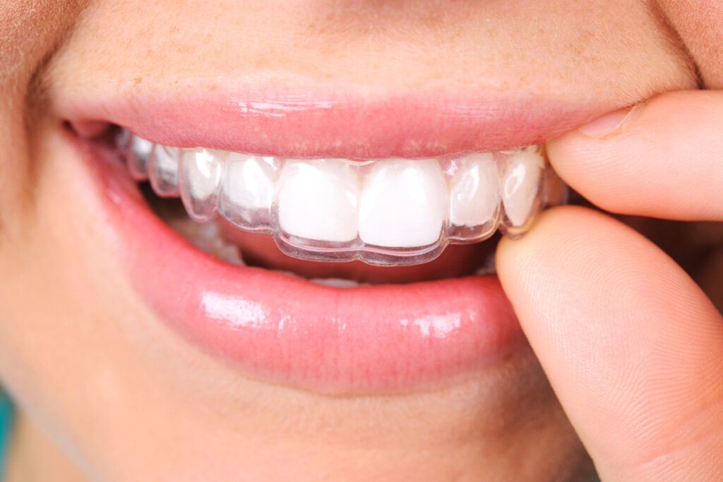 Choosing an Invisalign Provider in Chicago: What Questions to Ask