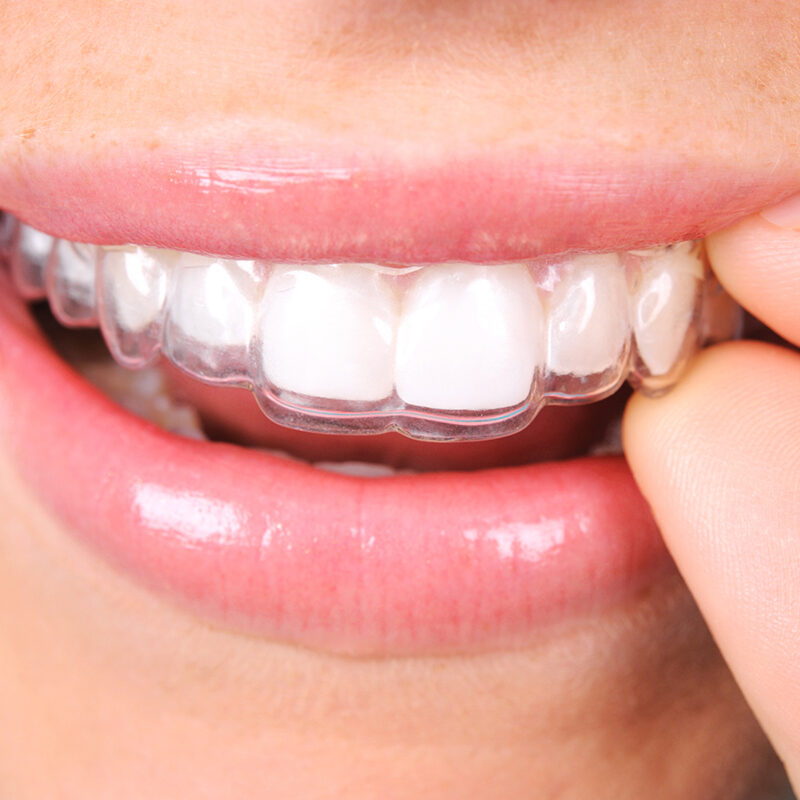 Choosing an Invisalign Provider in Chicago: What Questions to Ask